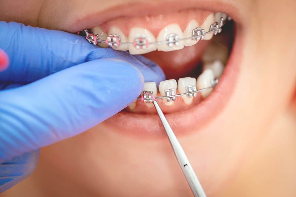 Braces cost in Malaysia