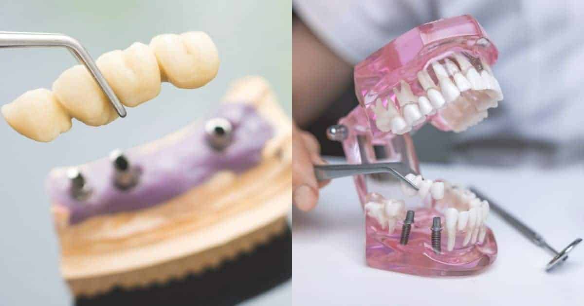 Dental Bridge Cost in Malaysia